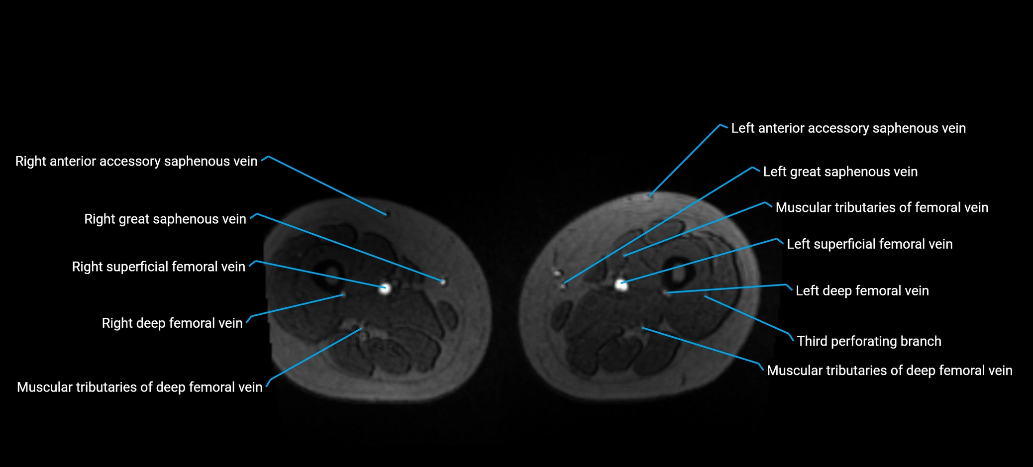 MRV abdomen pelvis & lower limb axial cross sectional anatomy labelled MRI image 280 (1).webp